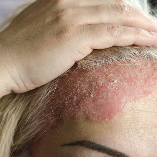Shea Butter: Your Secret Weapon Against Dry Skin Woes