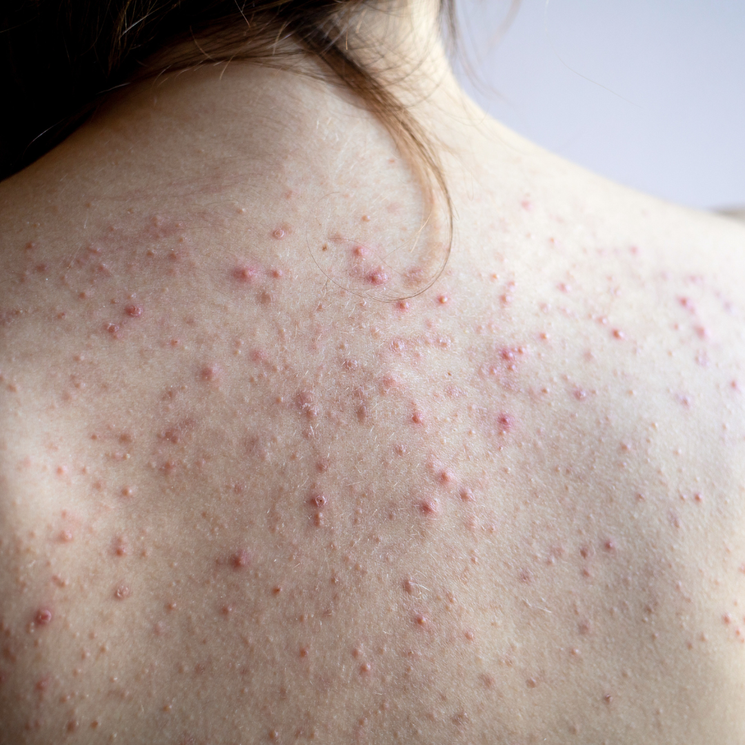 Shea Butter for Back Acne with Yateou's Personalized Formulations