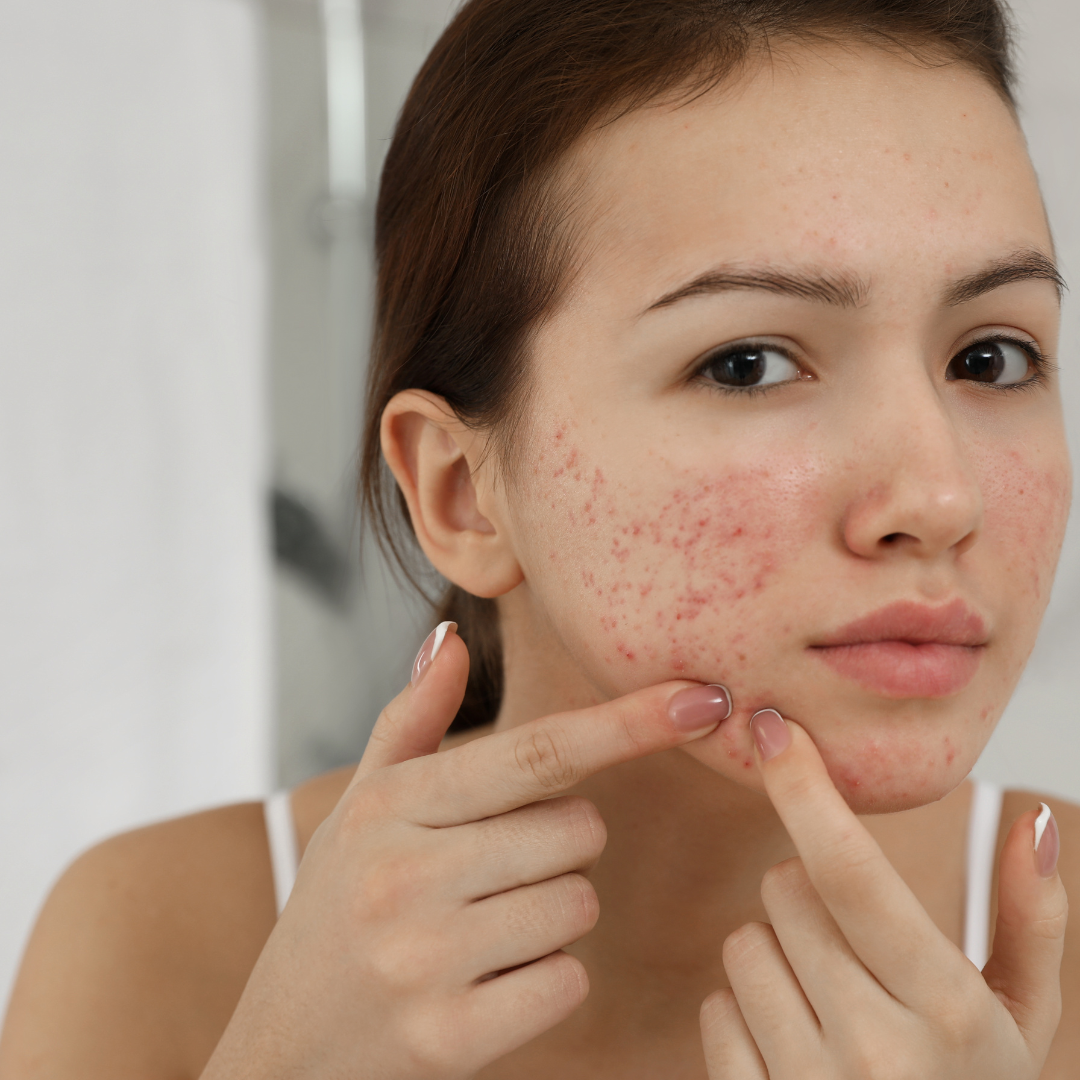 Shea Butter Magic: Your Guide to Clear Skin with Yateou